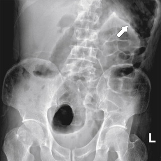 Figure 5-45, Plain abdominal radiograph in a 36-year-old woman with nodular mucosal thickening ( arrow ) due to pseudomembranes from pseudomembranous colitis.