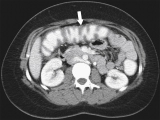 Figure 5-46, Axial contrast-enhanced CT in a 73-year-old woman with haustral thickening of the transverse colon caused by pseudomembranous pancolitis ( arrow ).