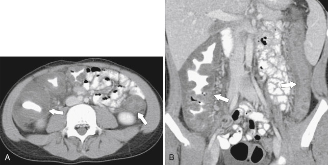 Figure 5-47, Axial ( A ) and coronal ( B ) contrast-enhanced CT in a 12-year-old boy with marked colonic thickening ( arrows ), particularly the right colon due to E. coli colitis.