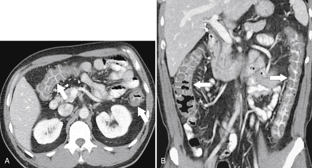 Figure 5-49, Axial ( A ) and coronal ( B ) contrast-enhanced CT in a 39-year-old man with marked pancolitic mucosal thickening ( arrows ) due to Campylobacter sp. infection. The appearances are similar to most other infectious colitides.