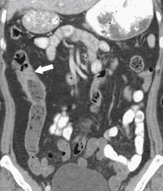 Figure 5-50, Coronal contrast-enhanced CT in a 49-year-old woman with focal mucosal thickening ( arrow ) of the ascending colon due to Strongyloides sp. infection.