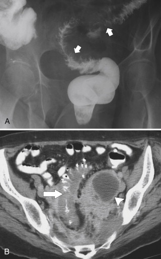 Figure 5-51, BE ( A ) and axial contrast-enhanced CT ( B ) in a 39-year-old woman with pelvic actinomycetes infection with sigmoid wall thickening ( arrow ) and narrowing ( small arrows ) and a pelvic abscess ( arrowhead ).