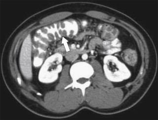 Figure 5-52, Axial contrast-enhanced CT in a 46-year-old woman with pancolitic mucosal thickening ( arrow ) due to Clostridium difficile colitis. The haustral thickening in the right colon conforms to the “accordion pattern.”