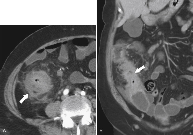Figure 5-54, Axial ( A ) and coronal ( B ) contrast-enhanced CT in a 31-year-old woman with marked colonic wall thickening and irregularity ( arrows ) and pericolonic inflammation or (stranding) due to acute colitic tuberculosis.