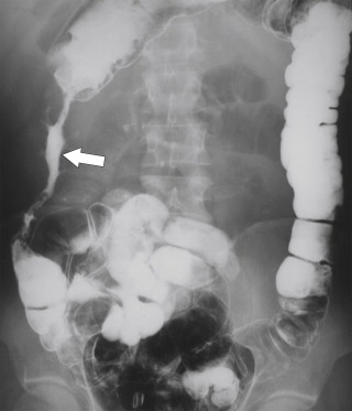 Figure 5-55, BE in a 37-year-old man with an ascending colon stricture ( arrow ) and irregular lumen due to colonic tuberculosis.