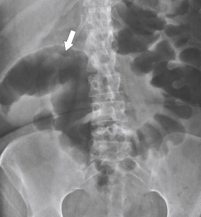 Figure 5-6, Plain abdominal radiograph in a 29-year-old man with friable colonic mucosa ( arrow ) and a toxic megacolon.