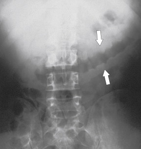Figure 5-7, Plain abdominal radiograph in a 33-year-old woman with marked colonic haustral thickening ( arrows ) due to an acute pancolitis from ulcerative colitis.