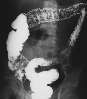 Figure 5-8, BE in a 23-year-old man with pancolitic granular appearance due to acute ulceration from ulcerative colitis.