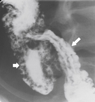 Figure 5-9, Single-contrast BE with nodular mucosal irregularity ( small arrow ) due to acute ulcerative colitis. There is associated fold thickening ( arrow ) in the terminal ileum due to backwash ileitis.