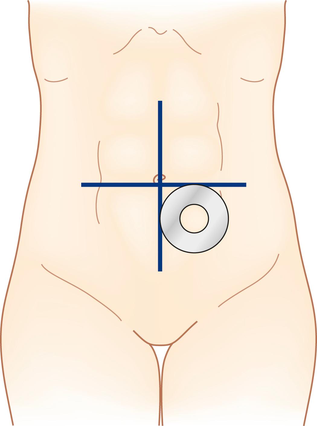 Fig. 52.15, Demonstration of the infraumbilical fat mound that is the ideal stoma site in many patients, here showing marking for a descending colostomy.