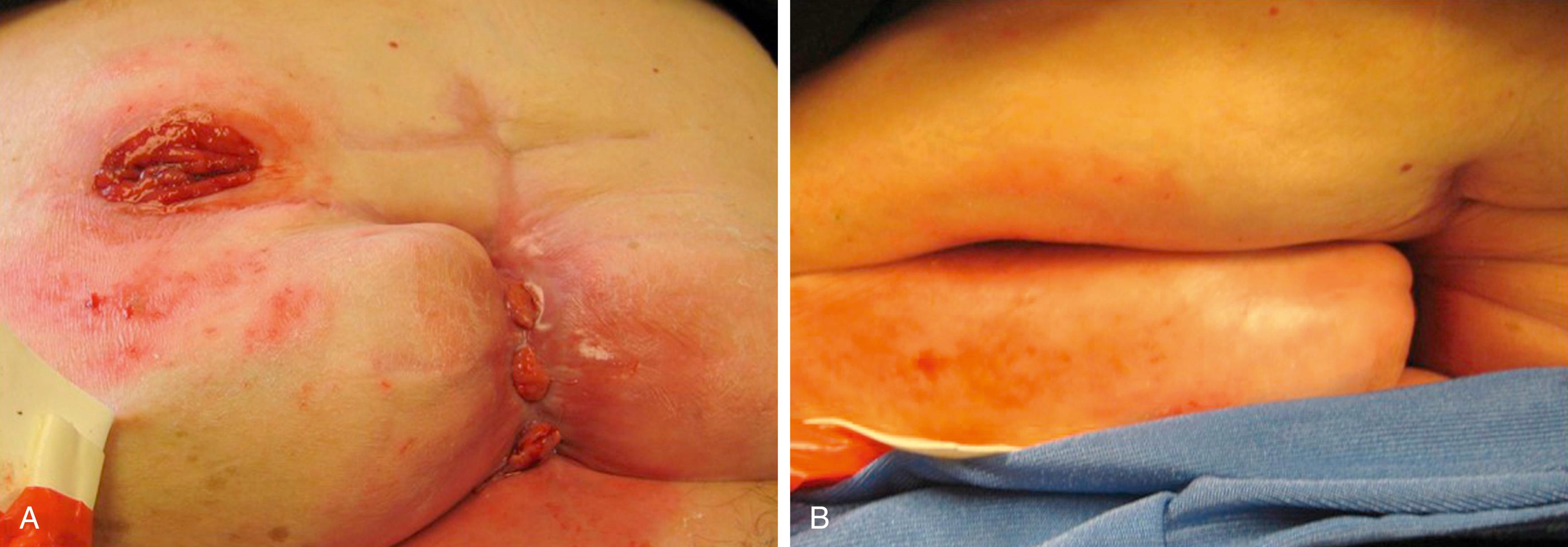 Fig. 52.16, Patient referred following surgery for ischemic colitis without preoperative stoma marking. (A) Patient in supine position. (B) Patient sitting up. Note the colostomy “disappears” within folds of her abdominal wall making pouching extremely difficult.