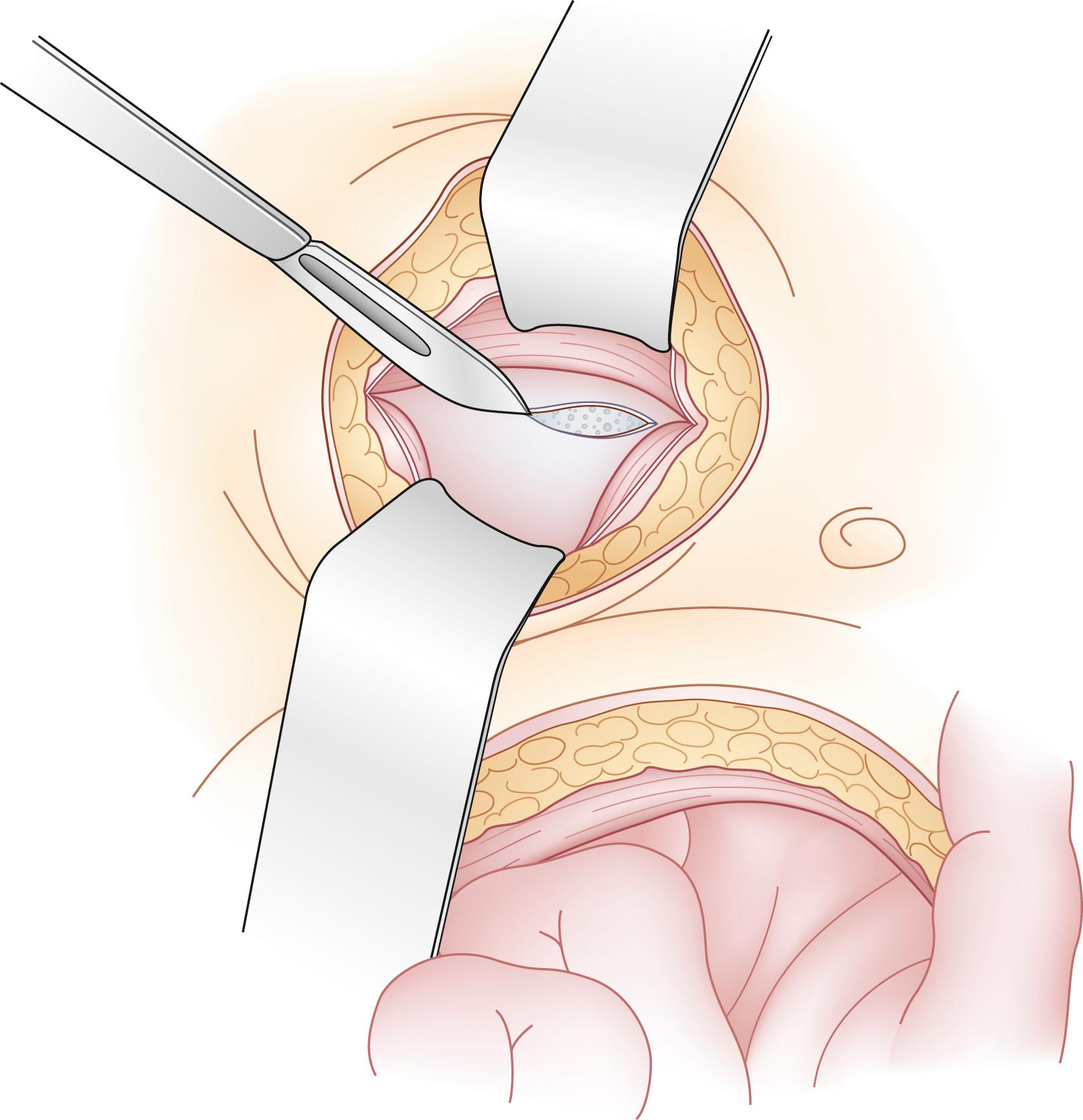 Fig. 52.18, In making the stoma aperture in the abdominal wall, the rectus muscle is split and the rectus sheath is divided sharply. In laparoscopic cases, one can cut down directly on the trocar inserted through this site.