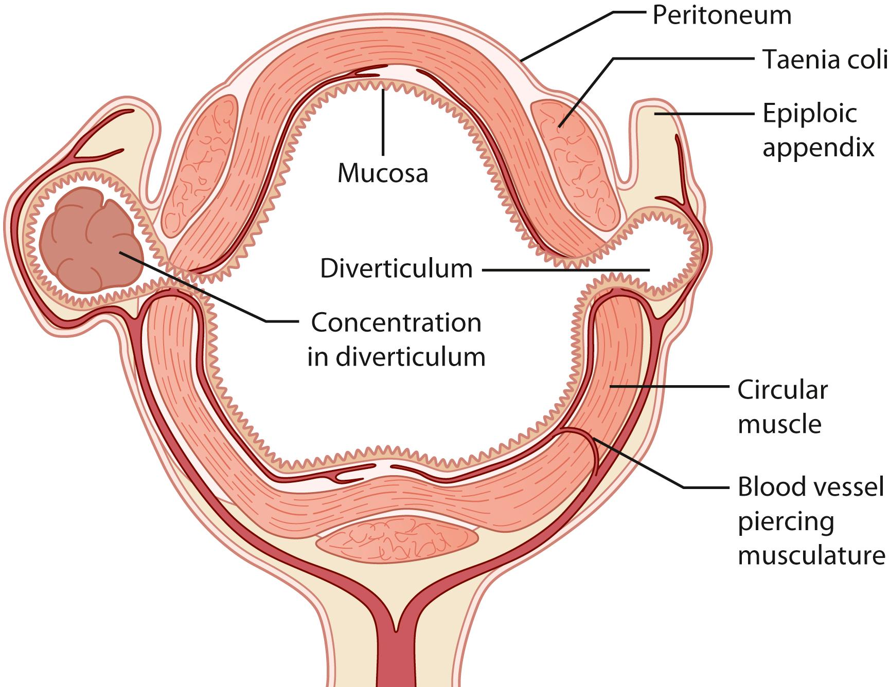 Fig. 52.20, Pathogenesis of diverticulosis.