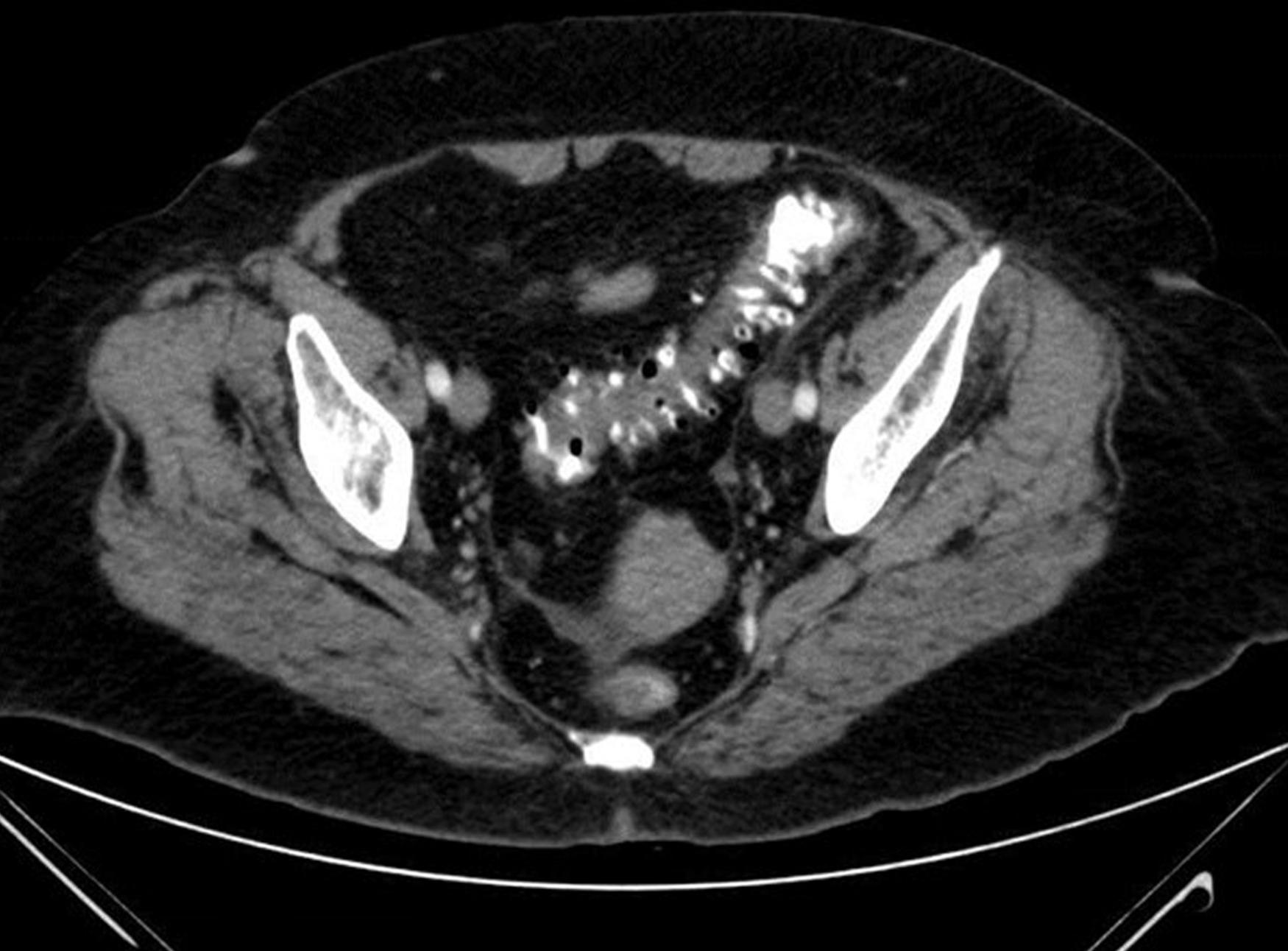 Fig. 52.21, Computed tomography scan of the pelvis showing extensive sigmoid diverticulosis .