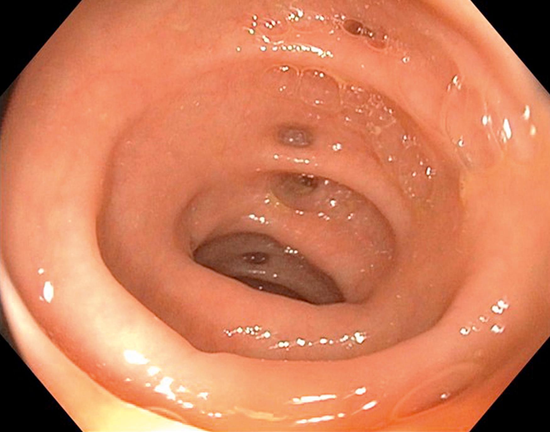 Fig. 52.22, Endoscopic view of diverticulosis.