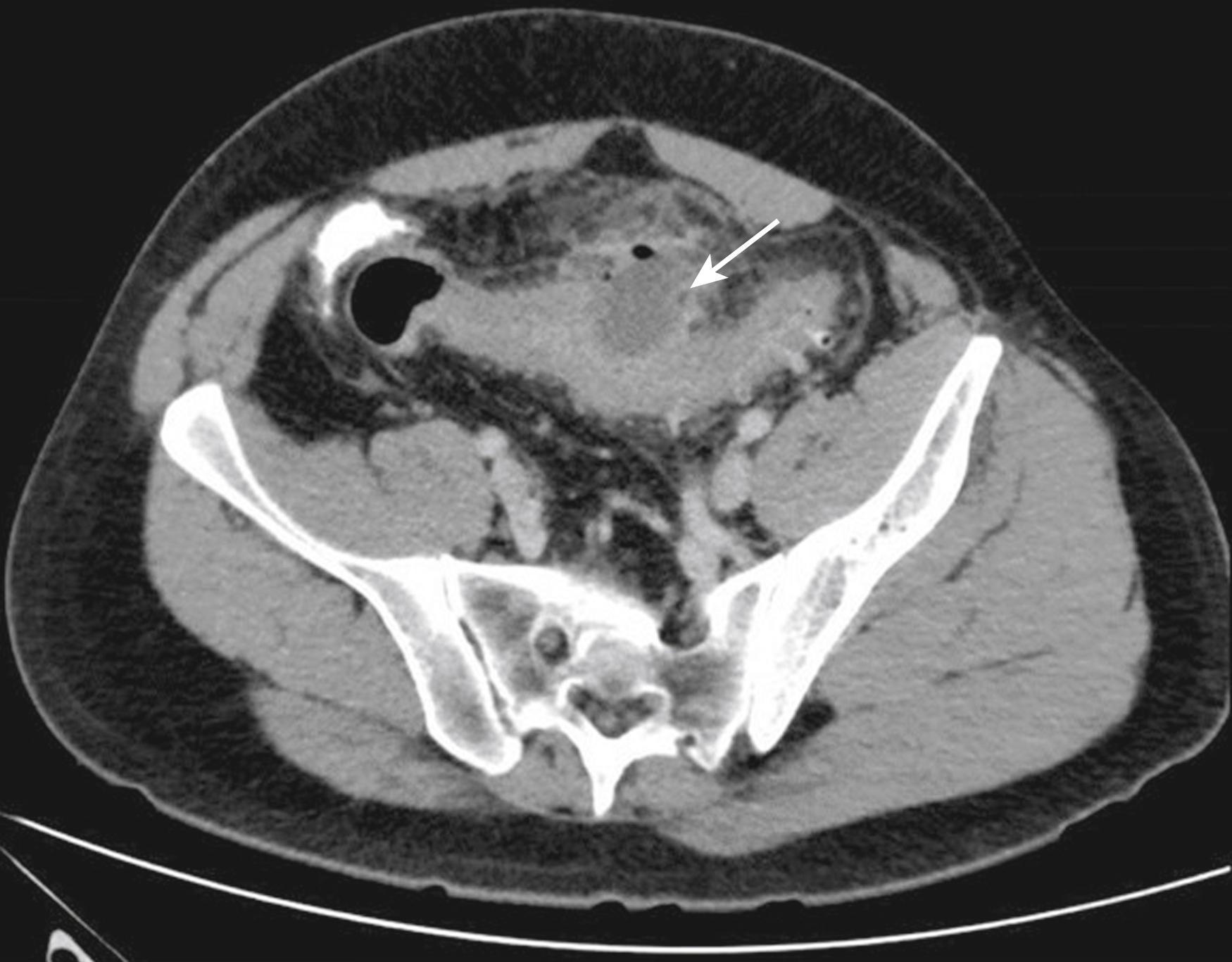 Fig. 52.23, Computed tomography of the pelvis demonstrating sigmoid diverticulitis with a thickened bowel wall, fat stranding a pericolonic abscess (arrow) , modified Hinchey grade 1b. 333