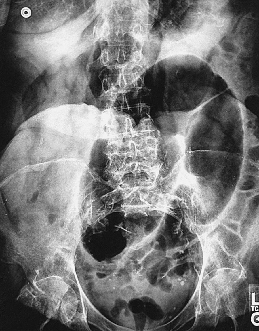 Fig. 52.24, Plain film of sigmoid volvulus. Note bent inner tube appearance.