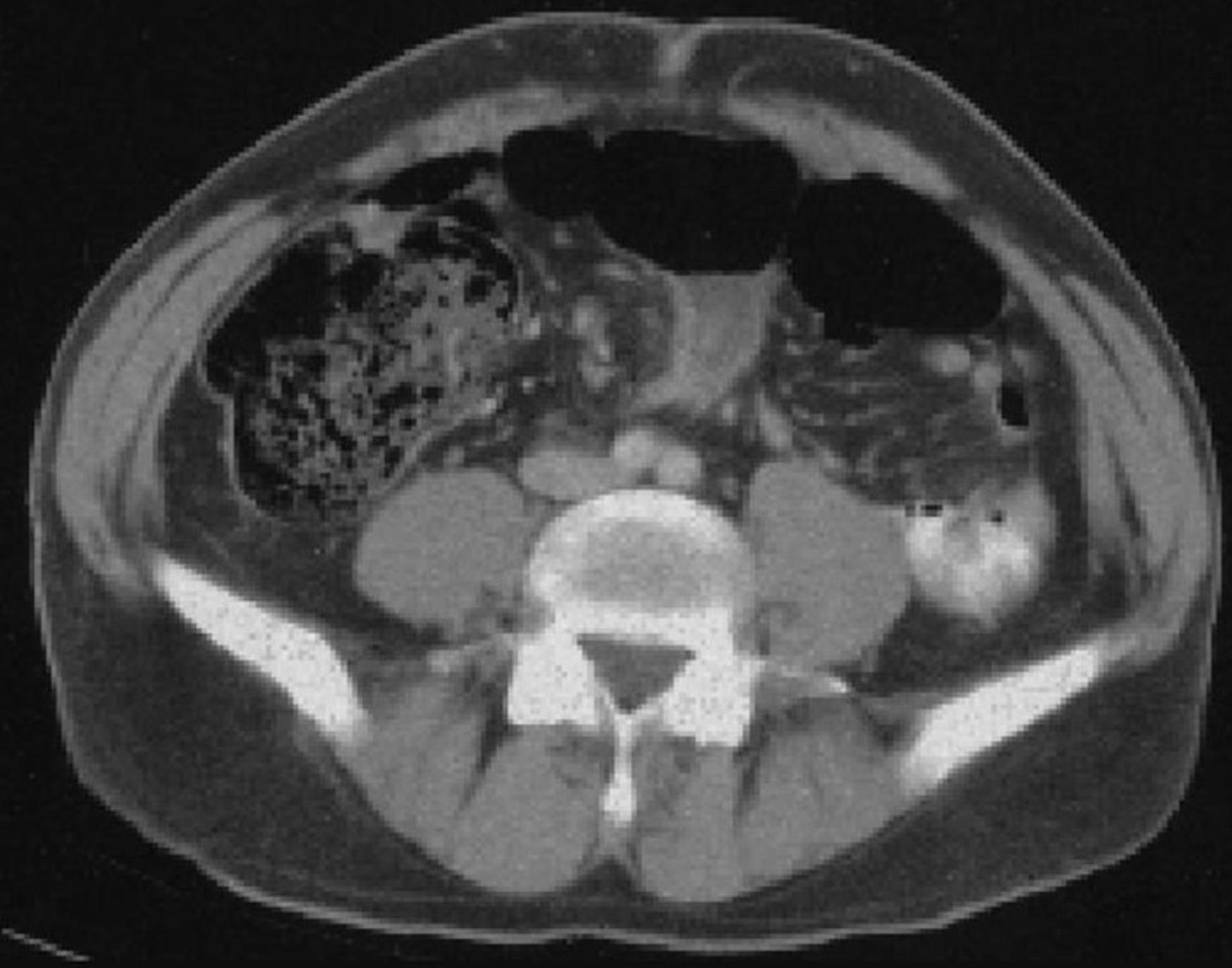 Fig. 52.25, Computed tomography scan of the abdomen in a patient with sigmoid volvulus. Note characteristic whorl in mesentery.