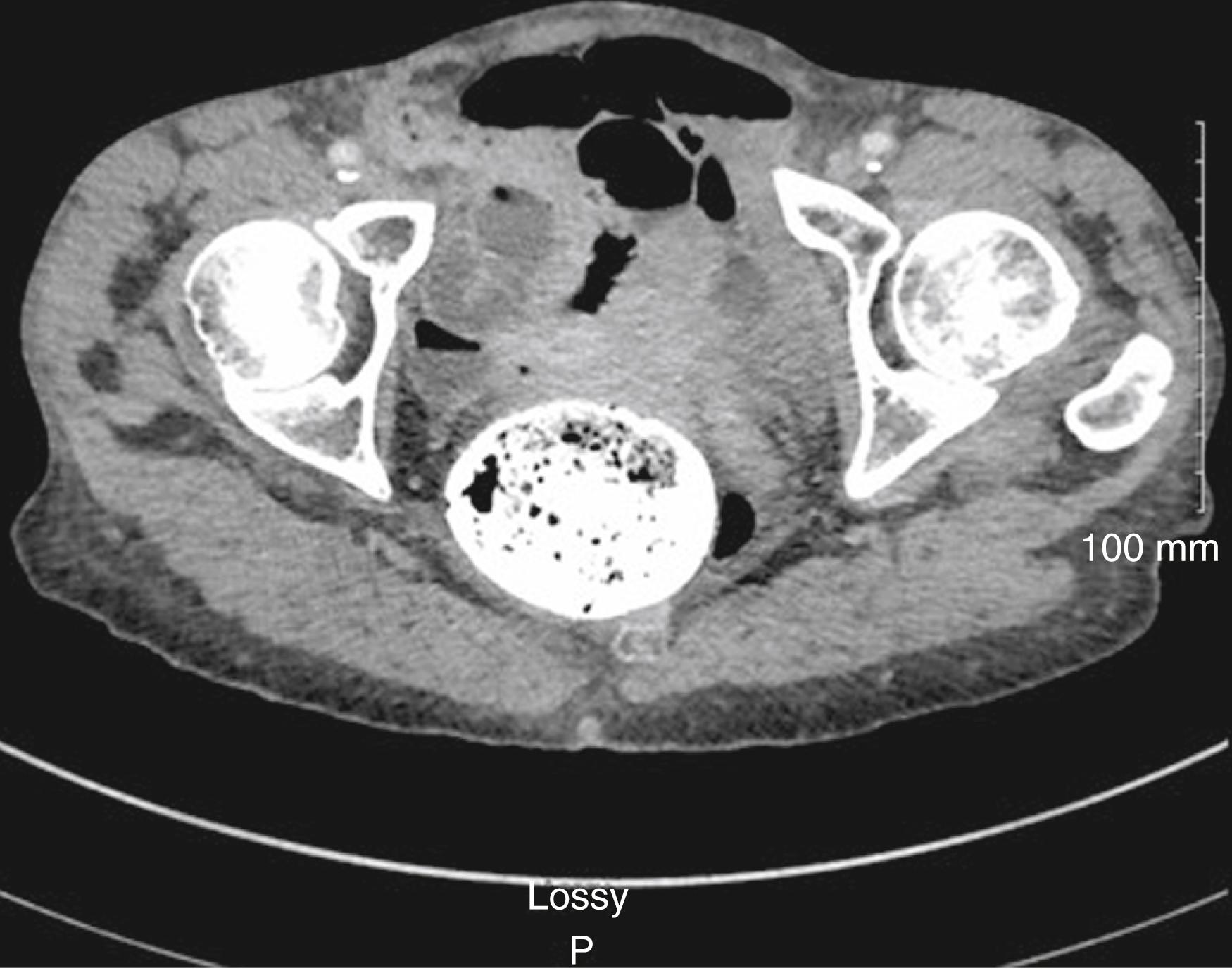 Fig. 52.26, Computed tomography scan of the pelvis showing a sizable barium impaction following a barium enema resulting in a large bowel obstruction. This patient required disimpaction in the operating room.