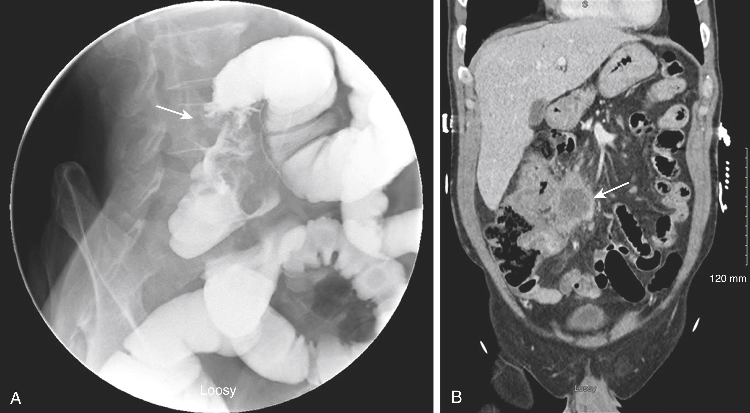 Fig. 52.27, (A) Gastrografin enema in a patient presenting with obstructing symptoms revealing an “apple-core” type lesion in the vicinity of the hepatic flexure ( arrow). (B) Computed tomography scan of the abdomen and pelvis in the same patient showing a large hepatic flexure carcinoma with perforation into the mesentery and associated mesenteric abscess ( arrow). Computed tomography–guided abscess drainage was not possible. This patient underwent extended right hemicolectomy with exteriorization of his ileocolic anastomosis as a loop ileostomy.