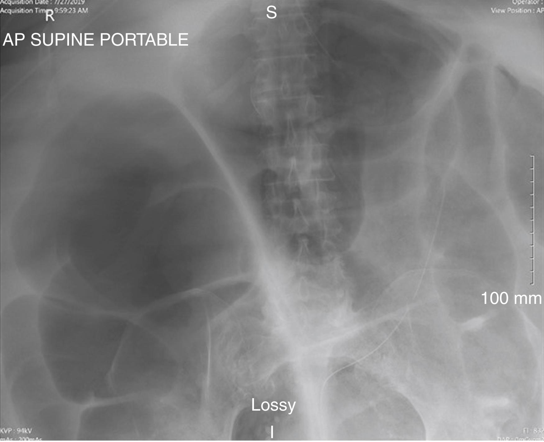 Fig. 52.28, Massive transverse colon distension due to Ogilvie syndrome in a woman with multiple comorbidities including a body mass index of 69, severe pulmonary hypertension, and cardiac disease.