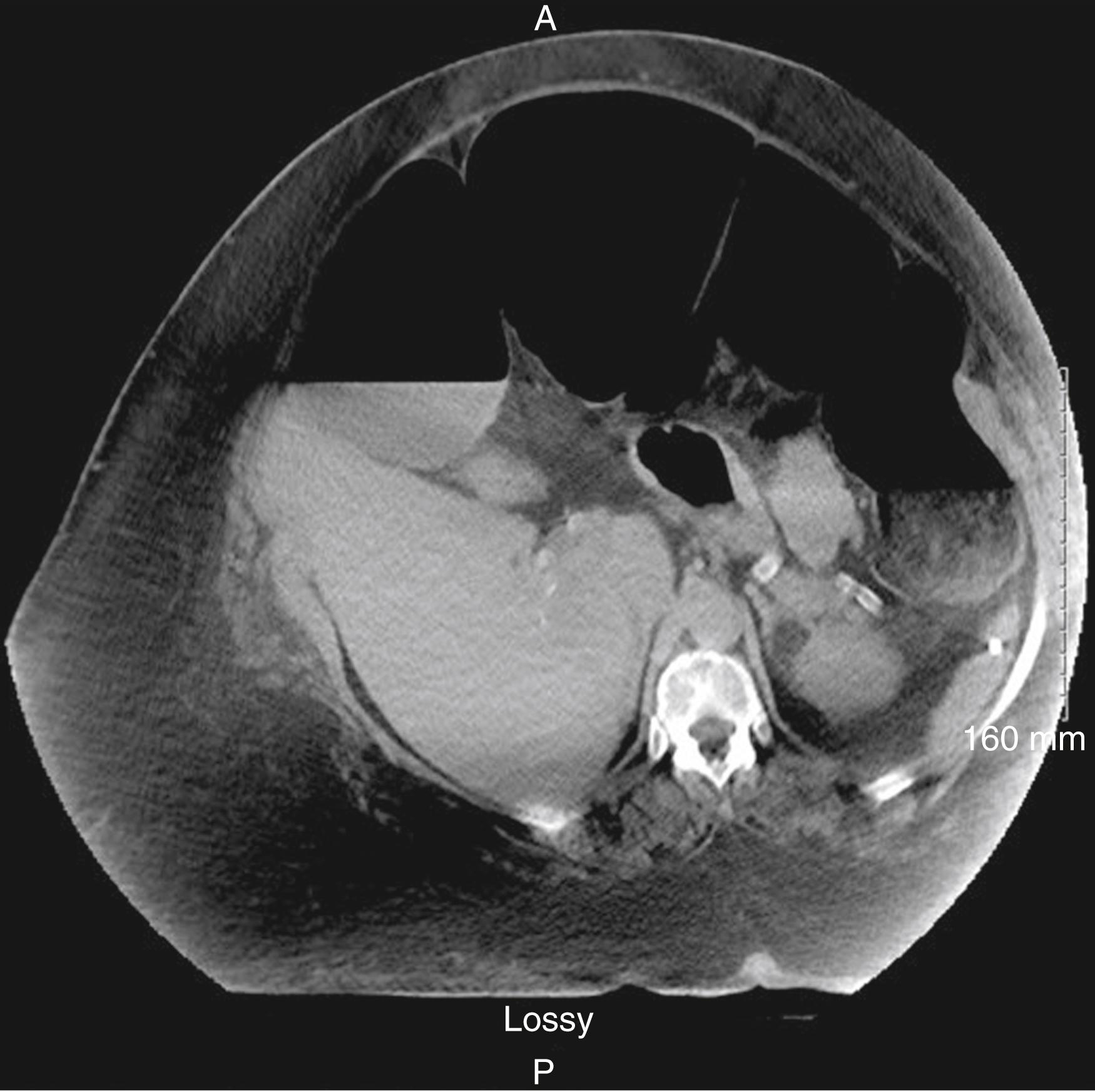 Fig. 52.29, Computed tomography scan showing massively distended colon without sign of ischemic change.