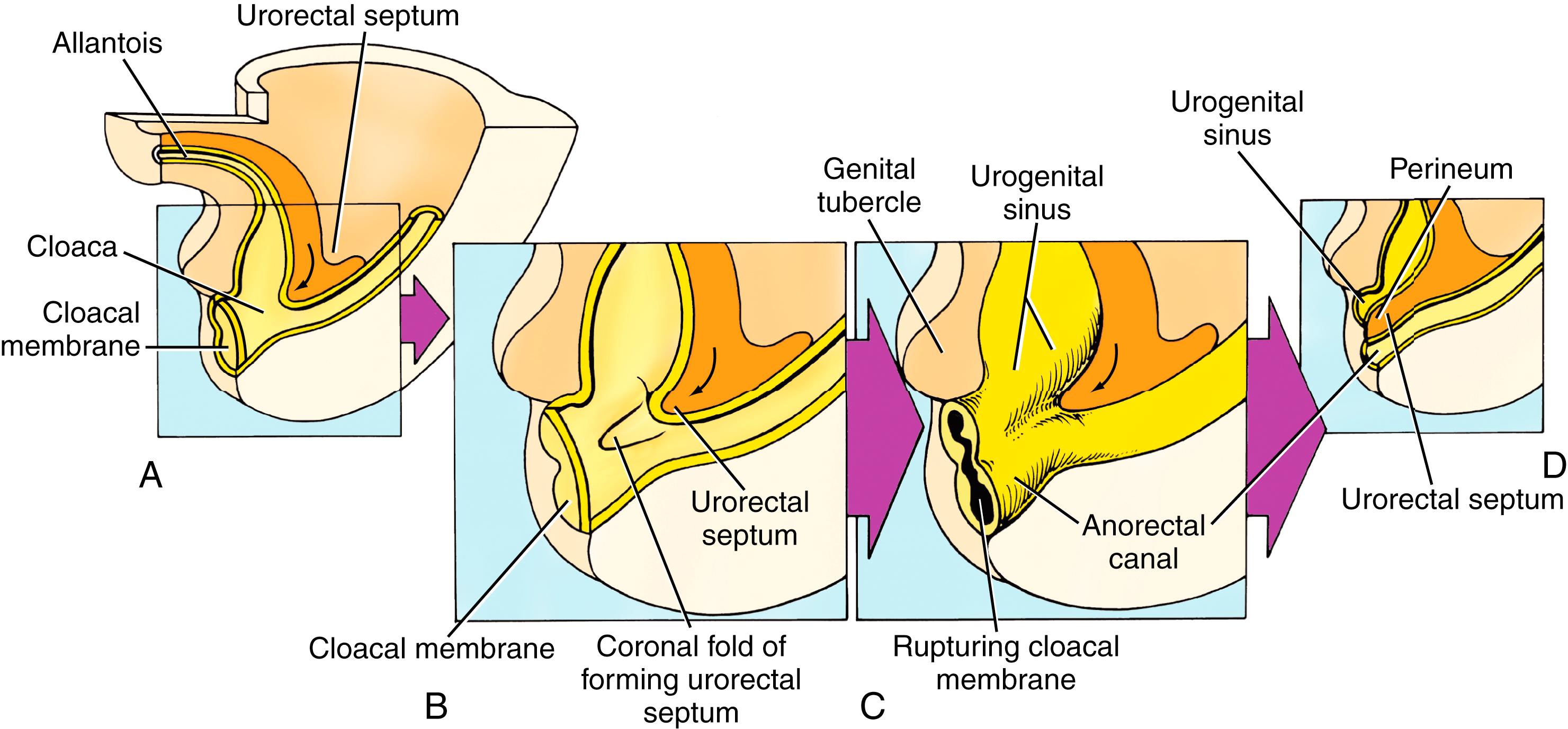 Fig. 52.3, Development of the distal rectum and anus. Progressive steps between 4 and 6 weeks in subdivision of the cloaca into a ventral primitive urogenital sinus and a dorsal anorectal canal (A–D). The urorectal septum is formed by the fusion of yolk sac extraembryonic mesoderm and allantois mesoderm, which produces a tissue wedge between the hindgut and urogenital sinus during craniocaudal folding of the embryo. As the tip of the urorectal septum approaches the cloacal membrane dividing the cloaca into the urogenital sinus and anorectal canal, the cloacal membrane ruptures, thereby opening the urogenital sinus and dorsal anorectal canal to the exterior. The tip of urorectal septum forms the perineum. A, B, and D, Sections through the cloacal and related endoderm-derived structures. C, Surface view of the caudal endoderm to better depict its three-dimensional shape. Curved arrows indicate the direction of growth of the developing urorectal septum.