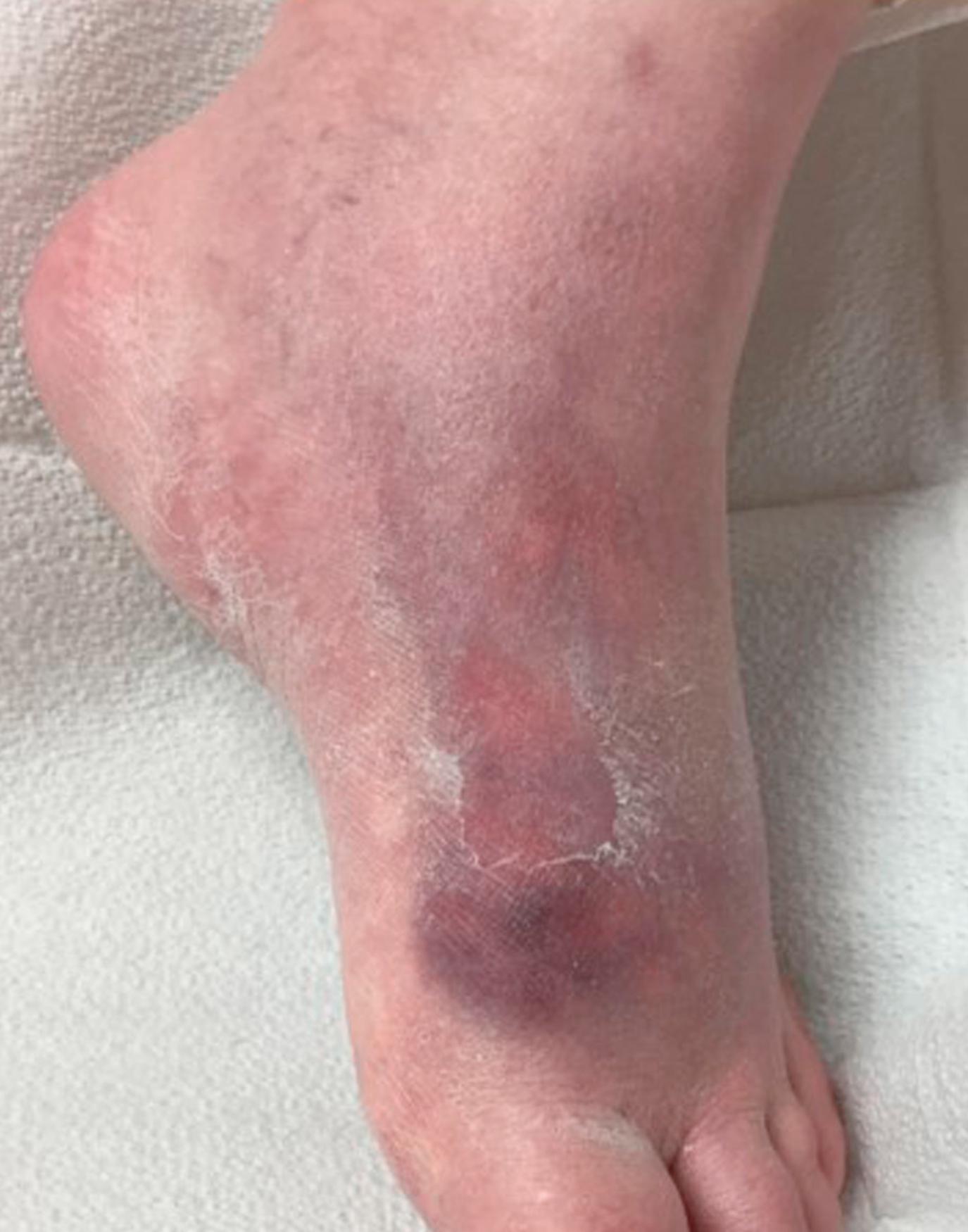Fig. 52.32, A patient with a Crohn disease flare and active erythema nodosum. Note the red purplish nodule on the dorsum of the foot.