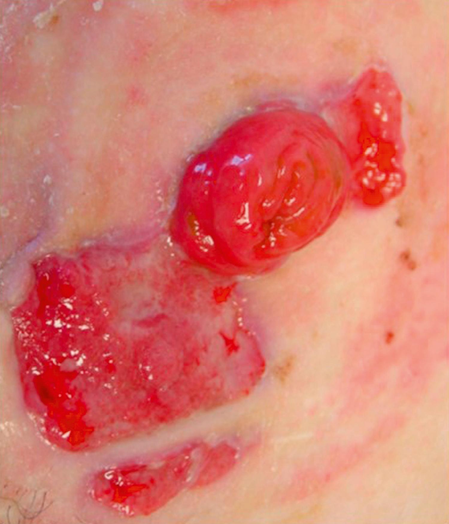 Fig. 52.33, Pyoderma gangrenosum adjacent to an end ileostomy in a patient with Crohn disease. Here, the lesions have started to heal with granulation tissue.