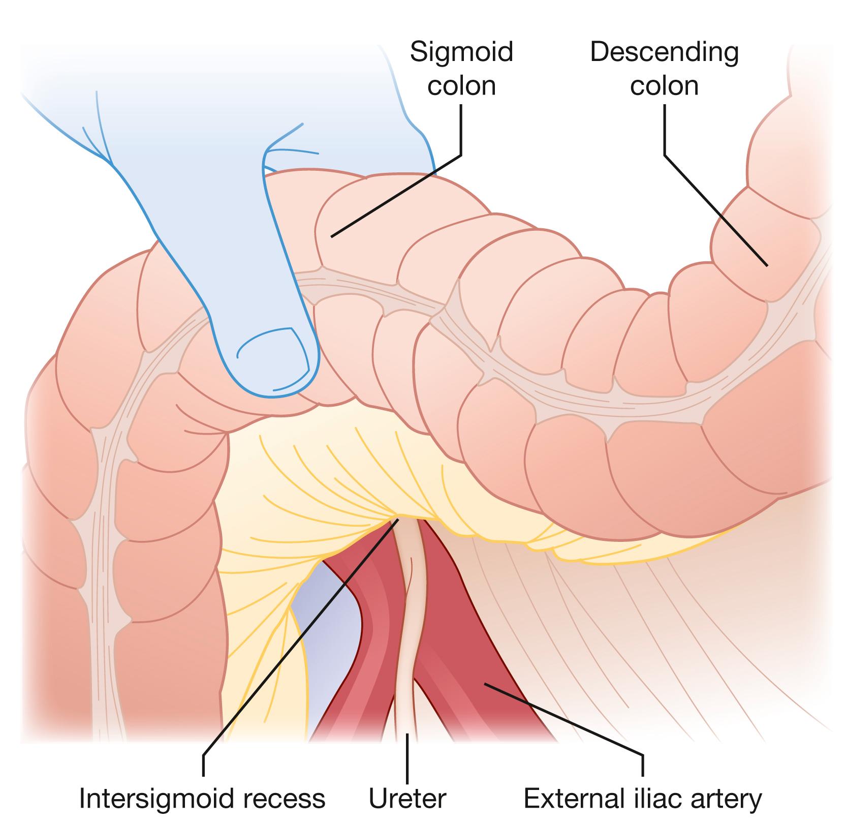 Fig. 52.7, The intersigmoid recess, the sigmoid colon being retracted upward and to the right.