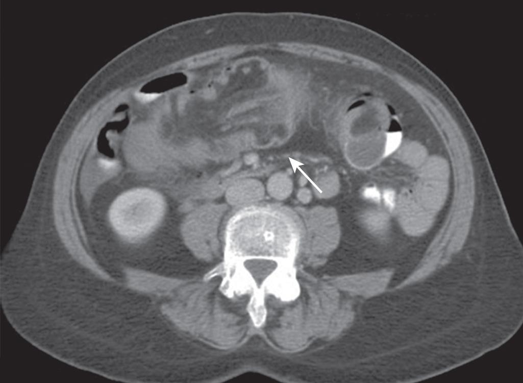 FIGURE 155.1, Intussusception on CT imaging. Axial view of intussusception, demonstrating a “bowel-within-bowel” configuration where mesenteric vessels can be seen compressed between the walls of the bowel.