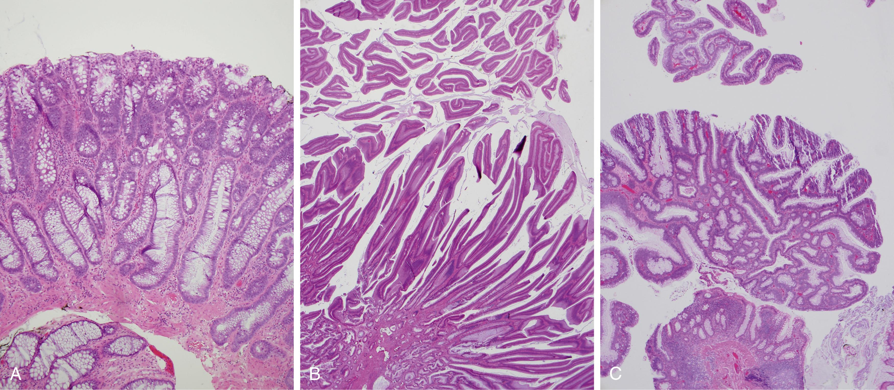 Fig. 126.1, Comparison of tubular, villous, and tubulovillous histology of adenomatous polyps. A, Tubular adenomas consist of branched, crowded glands arranged in a complex cerebriform pattern. B, Villous adenomas consist of glands that are long, finger-like fronds typically projecting from the polyp stroma to the surface without much branching. C , Tubulovillous adenomas exhibit a mixture of tubular and villous features.