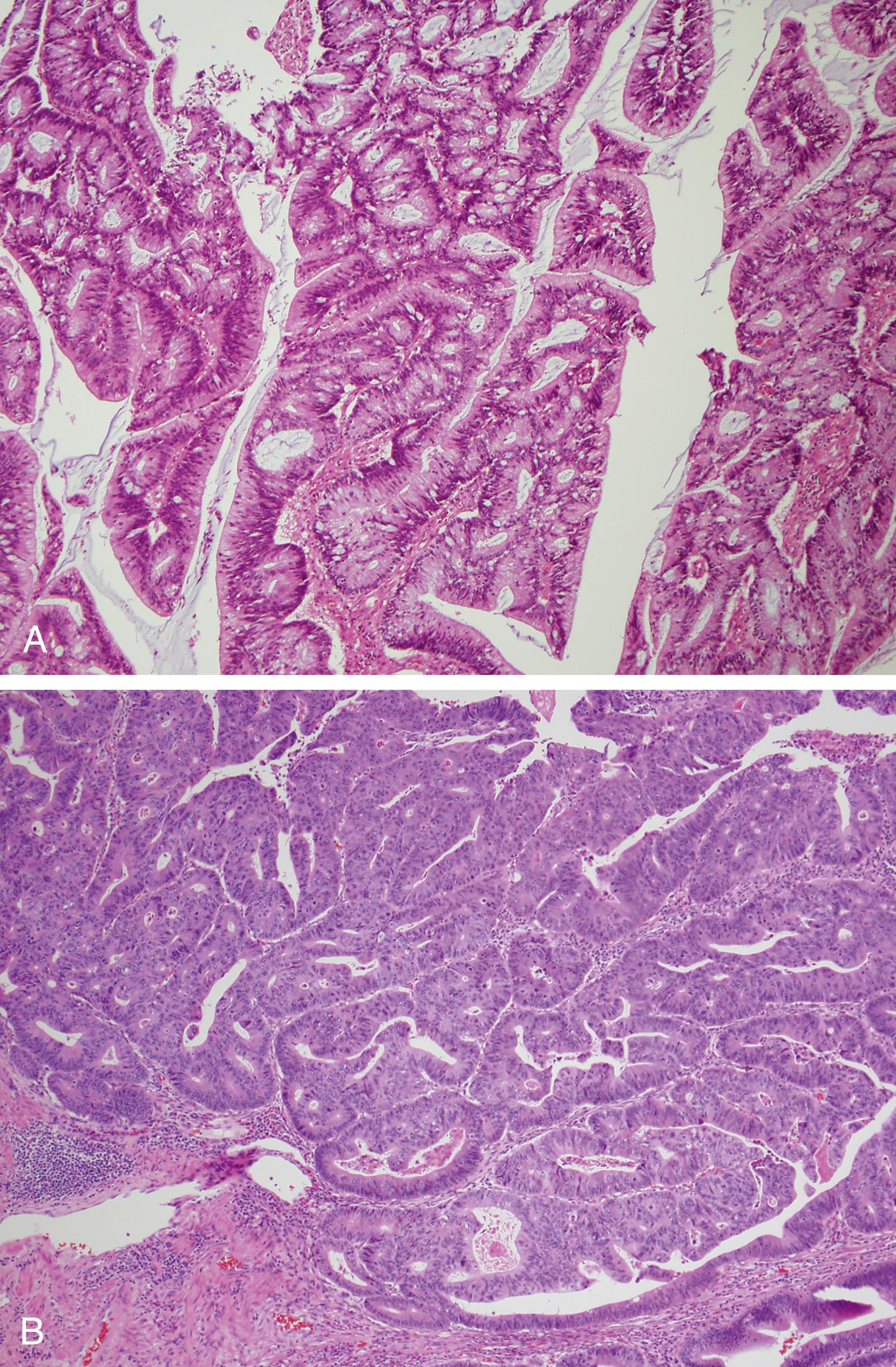 Fig. 126.2, Histopathologic comparison of high-grade dysplasia (HGD) and intramucosal carcinoma in an adenomatous polyp. A, HGD is characterized by stratified and pleomorphic nuclei, loss of goblet cell mucin, numerous and prominent nucleoli, increased nucleus-to-cytoplasm ratios and extreme glandular crowding. B , Adenoma with HGD and intramucosal carcinoma demonstrating nuclear pleomorphism and abnormal cellular polarity, resulting in a cribriform appearance (i.e., glands within glands). A focus of intramucosal carcinoma is seen in the center and is characterized by cells with pleomorphic nuclei and poor gland formation that are located in the lamina propria.