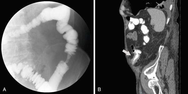 FIG 40.1, An “apple-core” lesion, which is pathognomonic for colonic adenocarcinoma, was found on A, a barium enema and B, on sagittal-views on a computed tomography (CT) scan. This left-sided colon stricture measured approximately 3 cm in length and would be ideal for stenting (as palliation or to assist in a single-stage surgical resection), as the proximal and distal colonic segments are straight and as this is a single stricture that is relatively short.