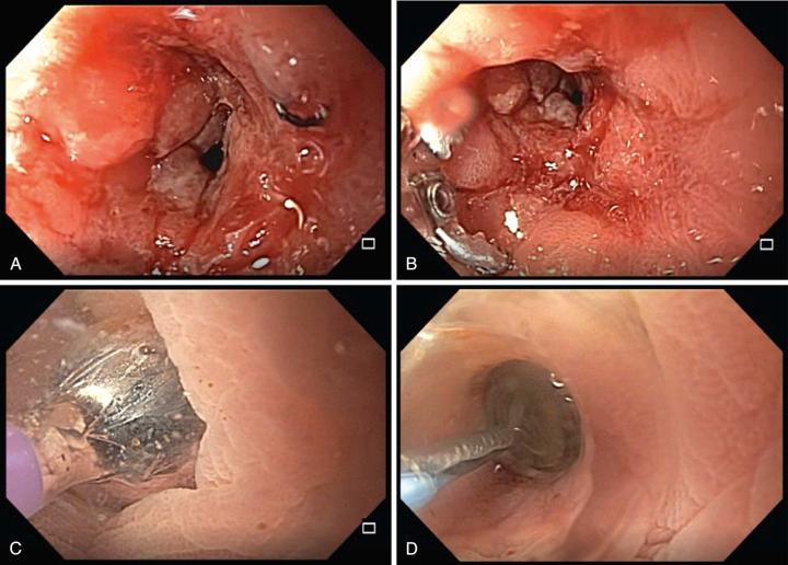 FIG 40.2, A patient with a history of colonic diverticulitis who underwent sigmoid colectomy and colostomy with subsequent takedown of the colostomy. A, She developed a tight stricture at the left-sided colorectal anastomosis that was erythematous and edematous. B, The stricture was approximately 3 mm in width (compared to opened biopsy forceps). C, A long 0.035-inch guidewire was passed across the stricture and a through-the-scope dilating balloon was used to dilate the stricture to 11 mm. D, Water was infused and the balloon was pulled close to the scope lens enabling visualization of the lumen of the stricture during dilation.