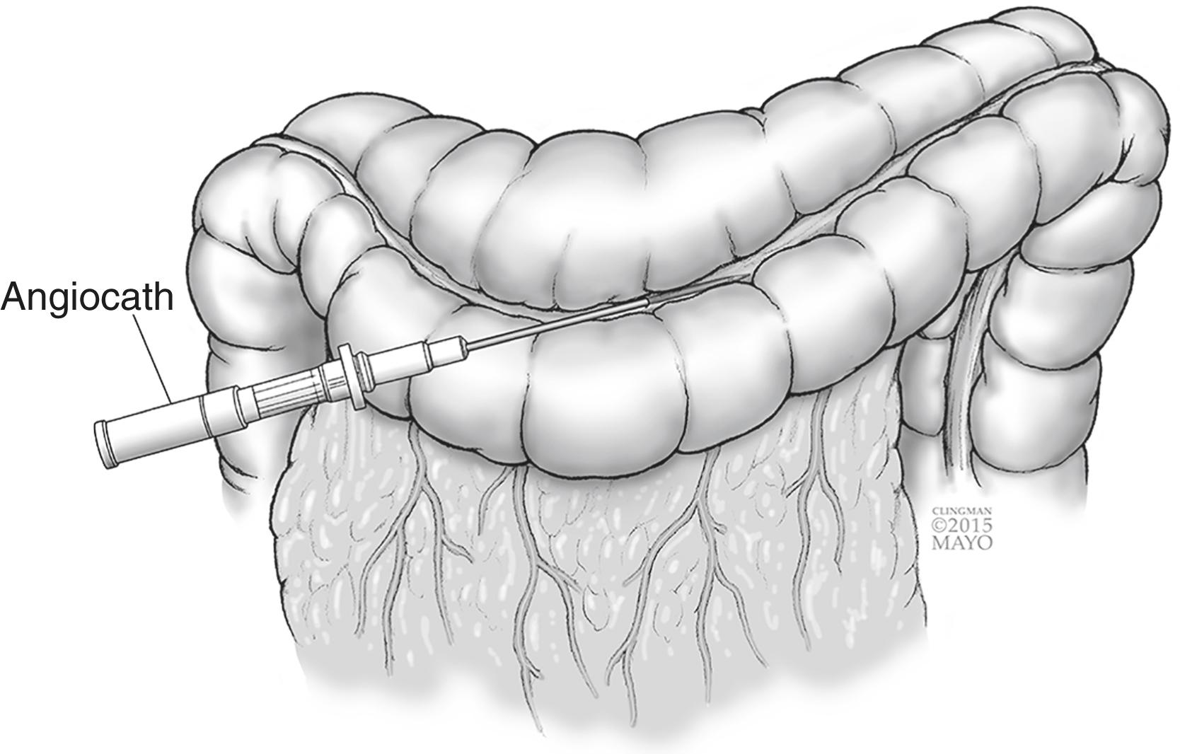 Figure 16.1, Needle decompression of colon.