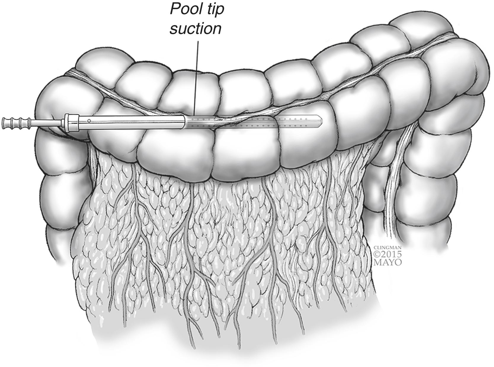Figure 16.2, Pool suction decompression of colon.