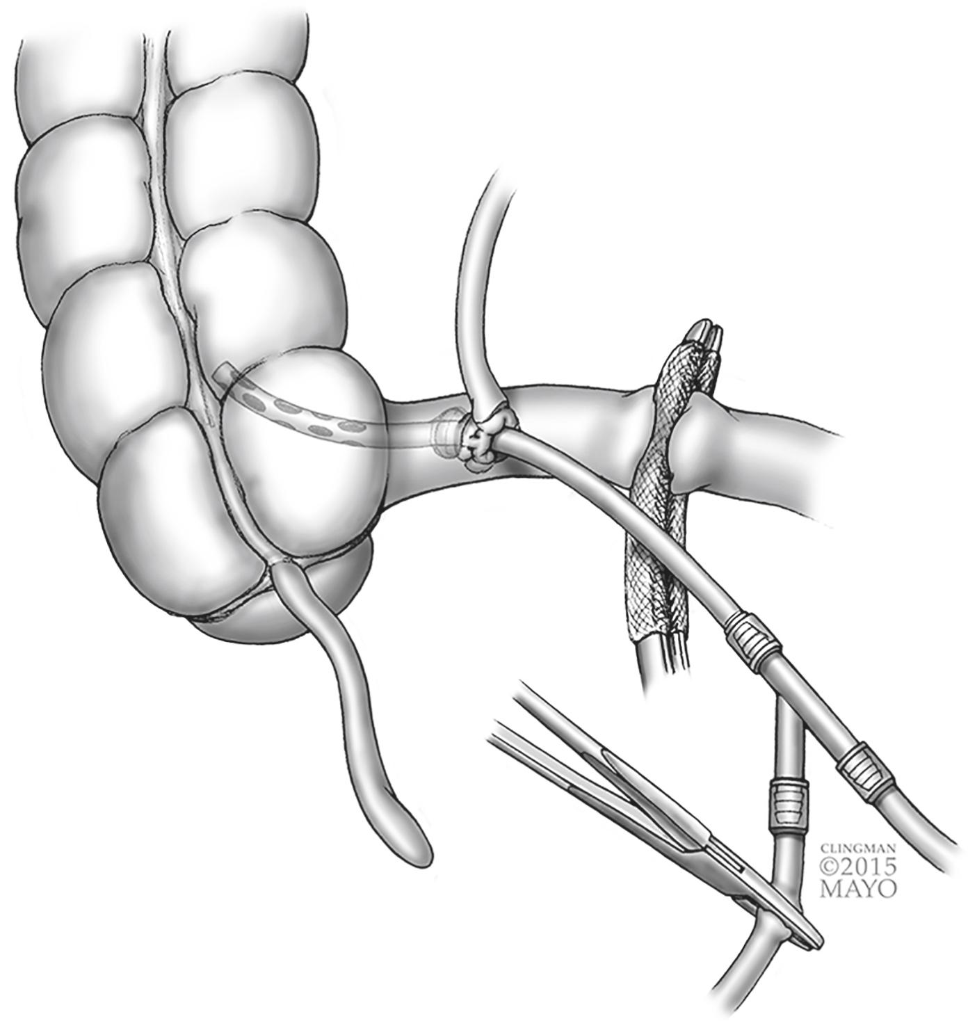 Figure 16.3, Catheter lavage and decompression of colon.