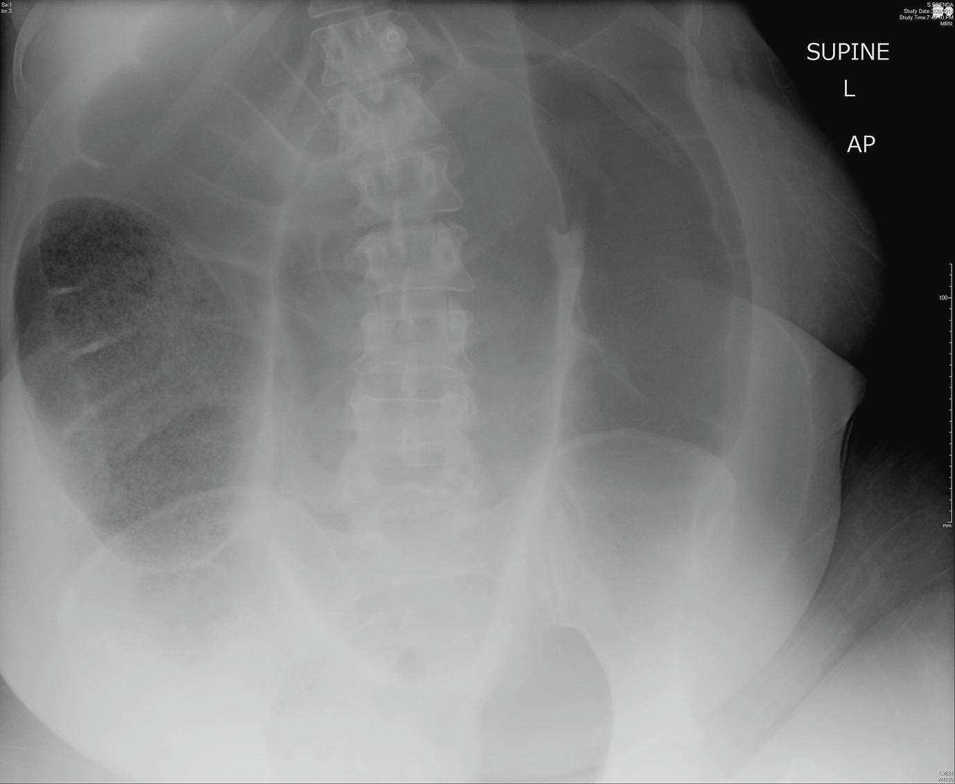 Figure 16.4, Sigmoid volvulus.