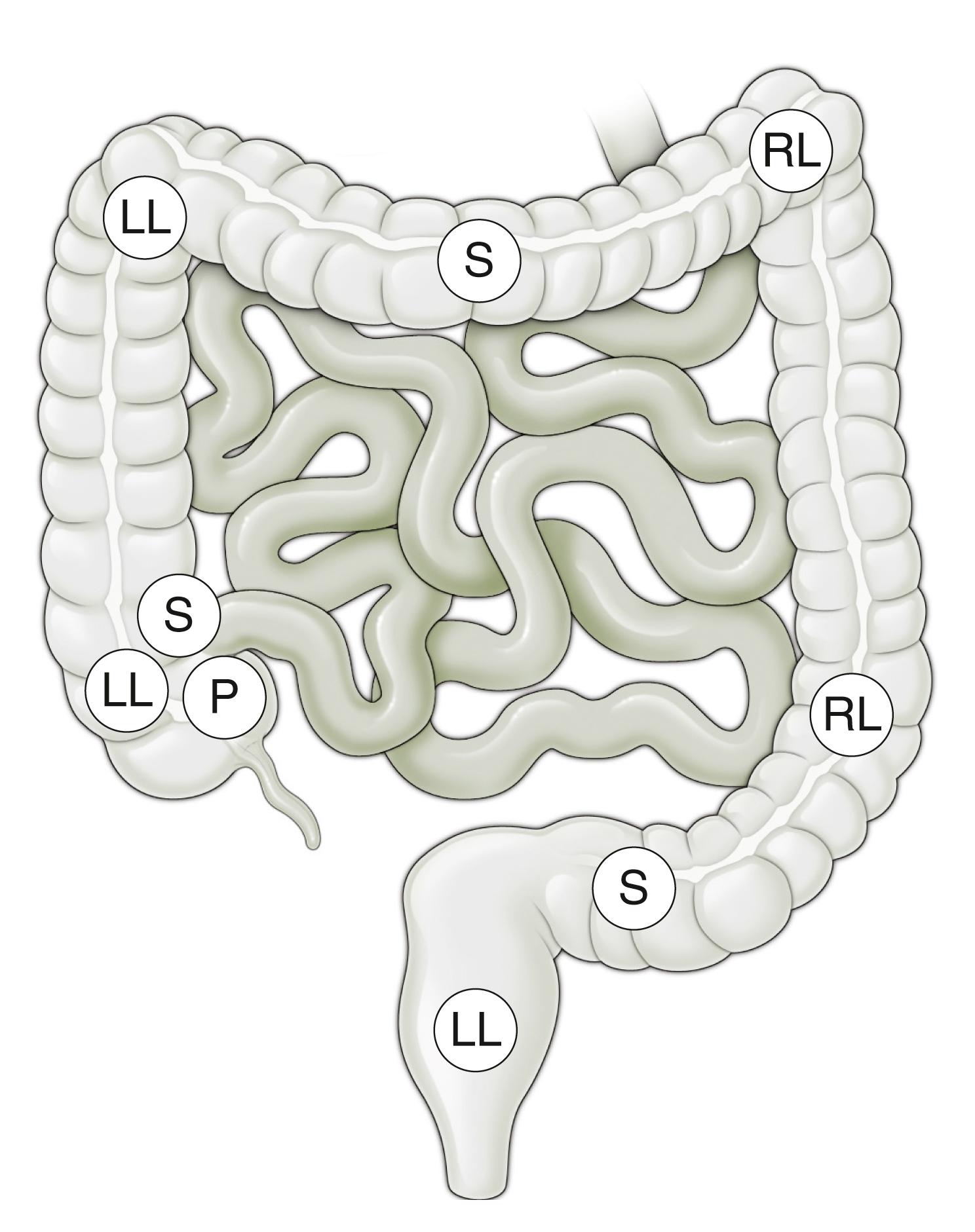 Fig. 61.11, Position change as indicated may aid insertion and optimizes views during extubation. LL , Left lateral; S , supine; RL , right lateral; P , prone.