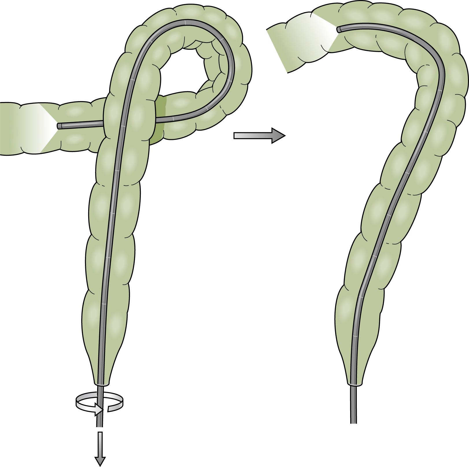 Fig. 61.12, Reduction of the Splenic Flexure Loop After Intubation of the Transverse Colon.