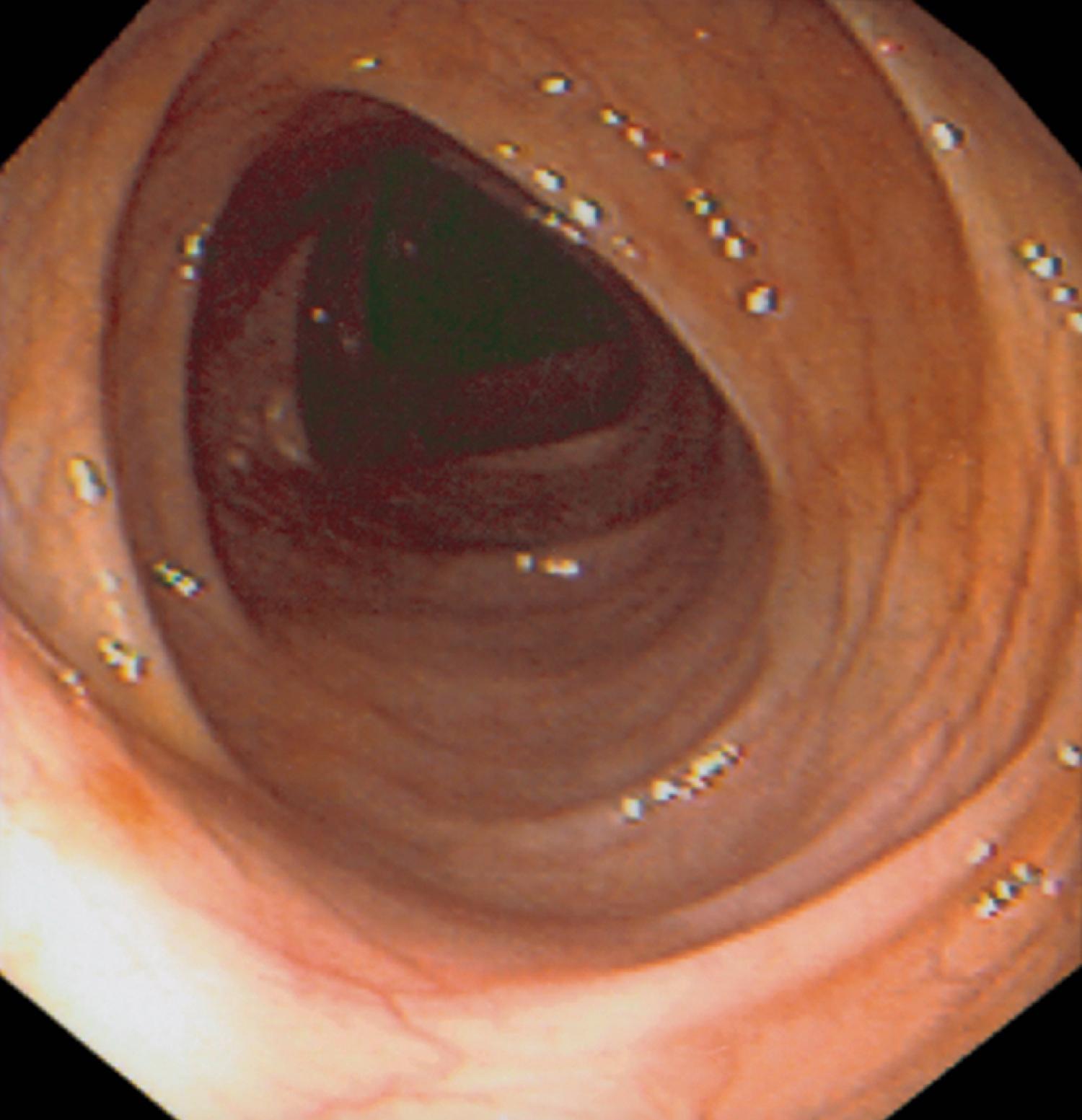 Fig. 61.13, Normal Colonic Mucosal Appearance of the Transverse Colon.