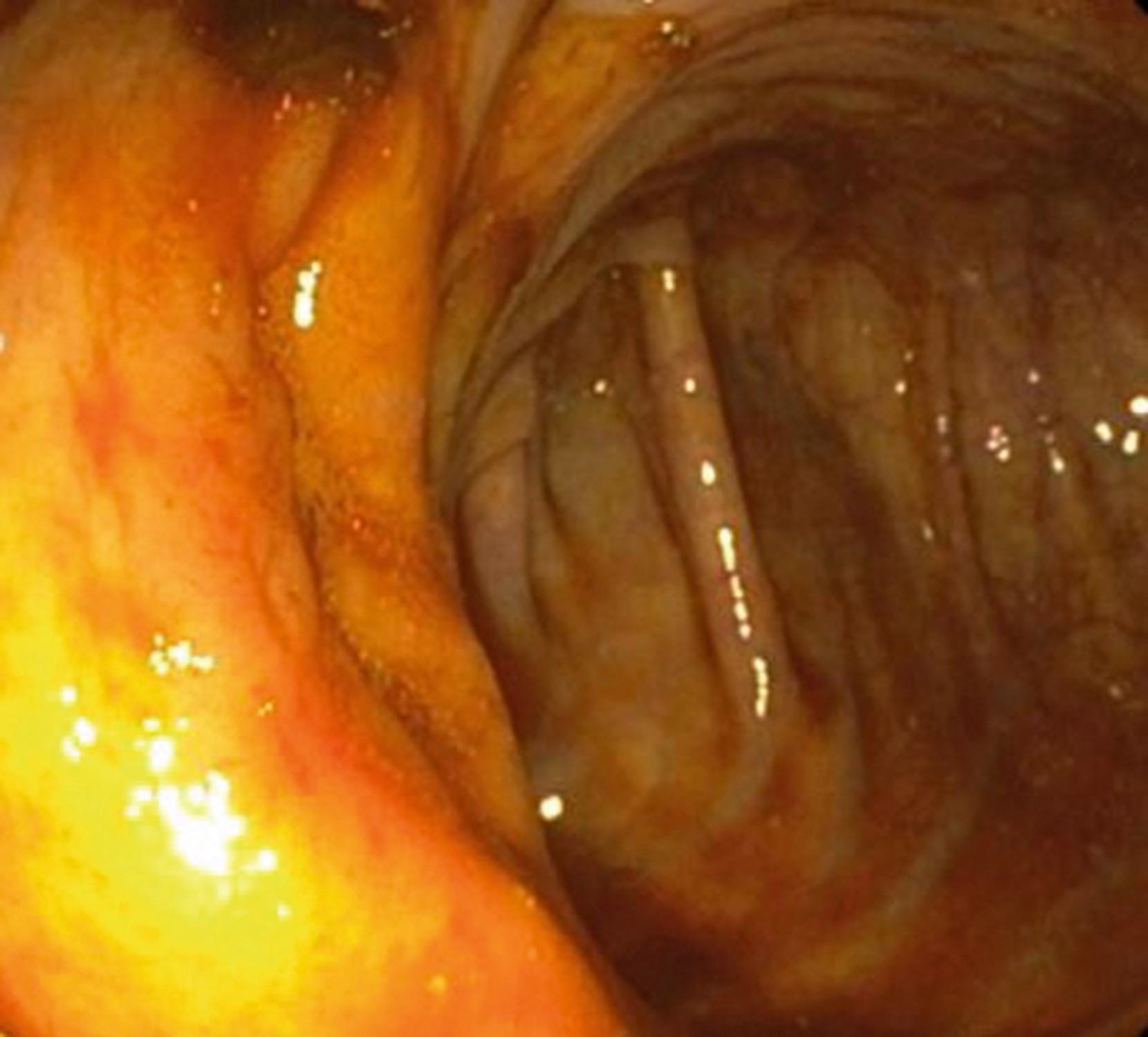 Fig. 61.14, Normal Appearance of the Ileocecal Valve.