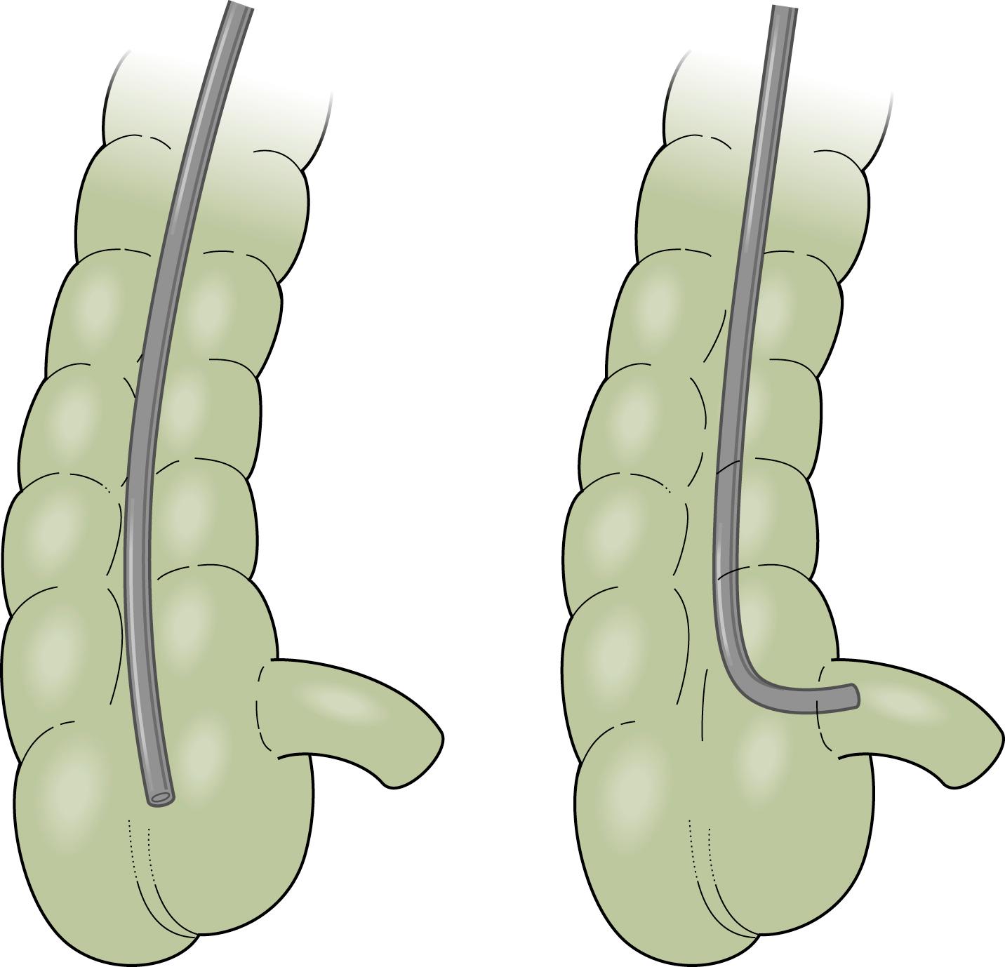 Fig. 61.15, The Ileocecal Valve Is Intubated by Tip Deflection Rather Than En Face .