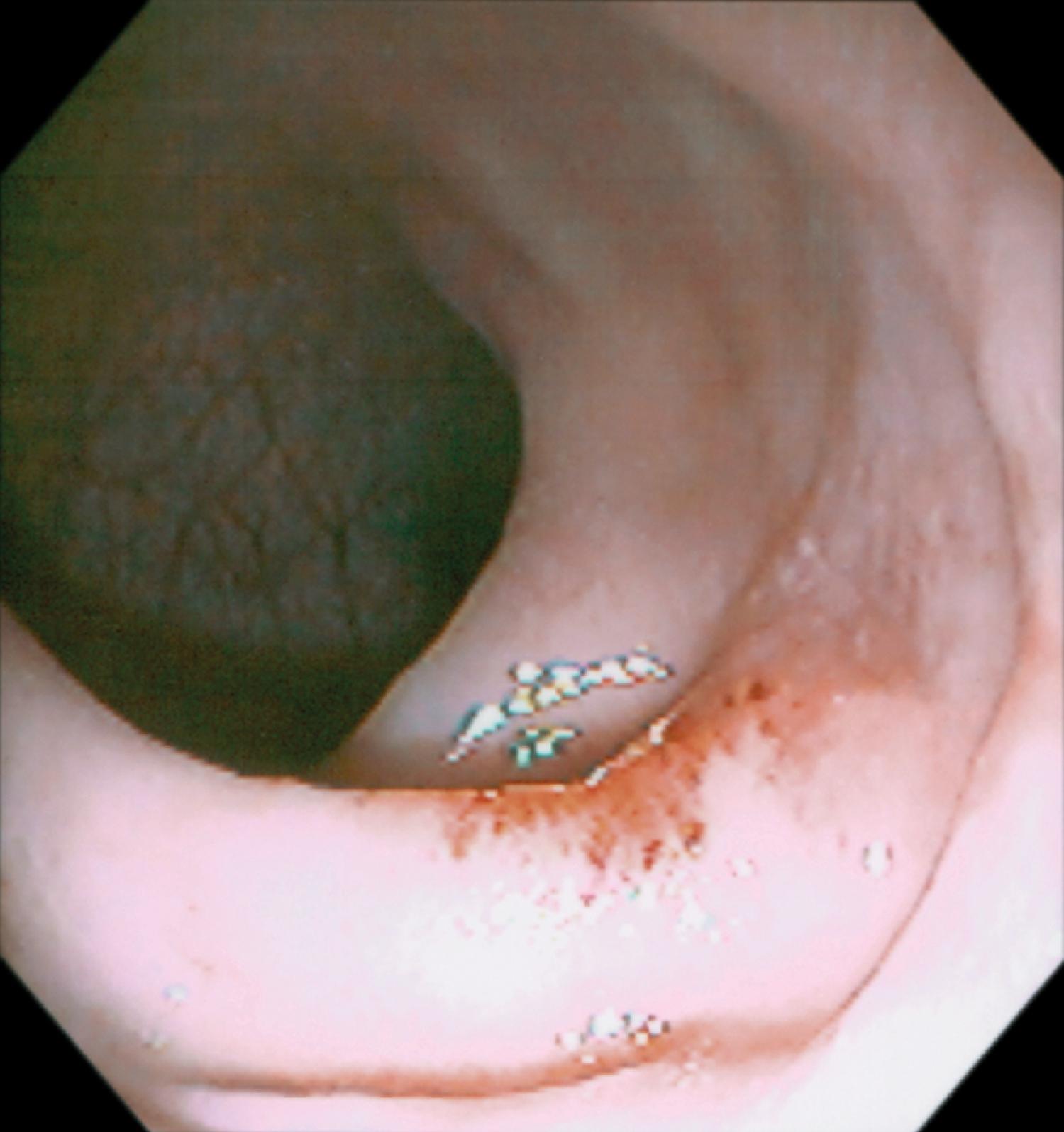 Fig. 61.2, Endoscopic Appearance of the Rectum in a Patient With Mucosal Prolapse.