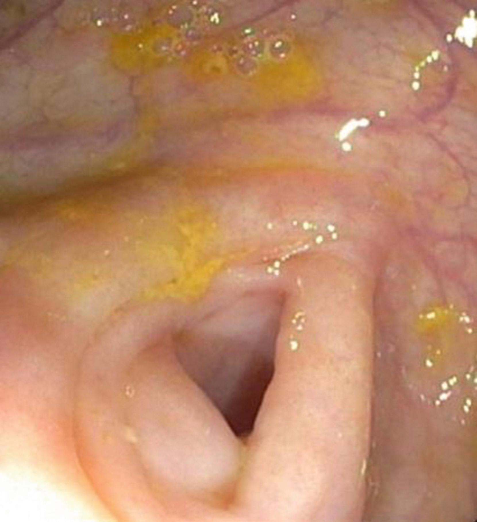 Fig. 61.4, Typical Appearance of the Appendiceal Orifice at Colonoscopy.