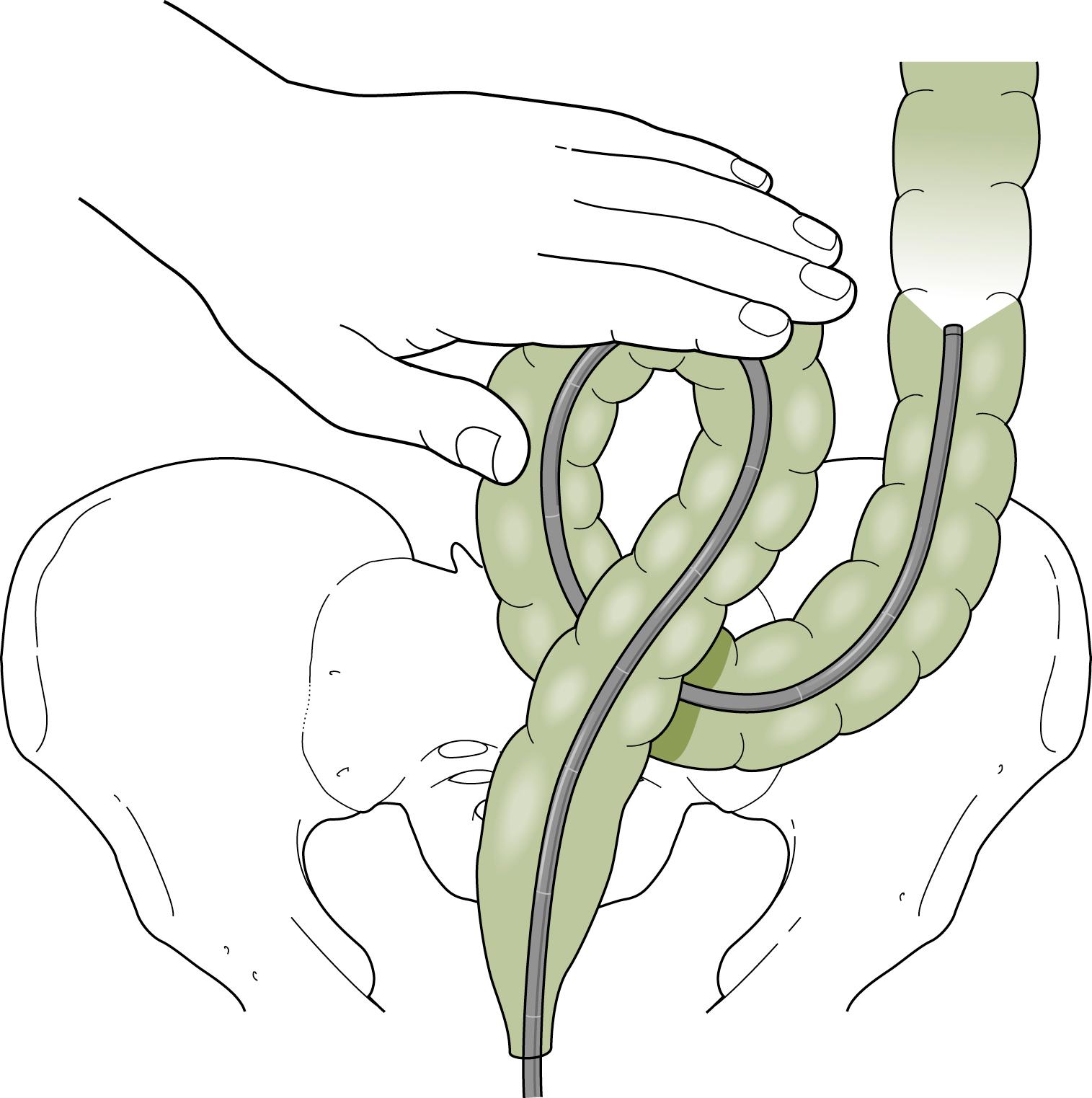 Fig. 61.10, Anterior Abdominal Pressure May Facilitate Scope Advancement by Increasing Resistance to Loop Formation.