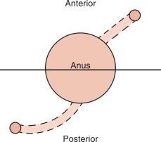 Figure 76-1, The Goodsall rule helps predict the location of the internal opening of an anal fistula based on the site of its external opening. Accurately determining the criminal crypt of fistula origin on the dentate line is important at the time of surgical treatment, generally fistulotomy. If the anus is divided into imaginary anterior and posterior halves in the coronal plane, posterior fistulas tend to curve into the posterior midline. Anterior fistulas shorter than 3 cm tend to proceed radially to the dentate line, whereas anterior fistulas longer than 3 cm may track back to the posterior midline.