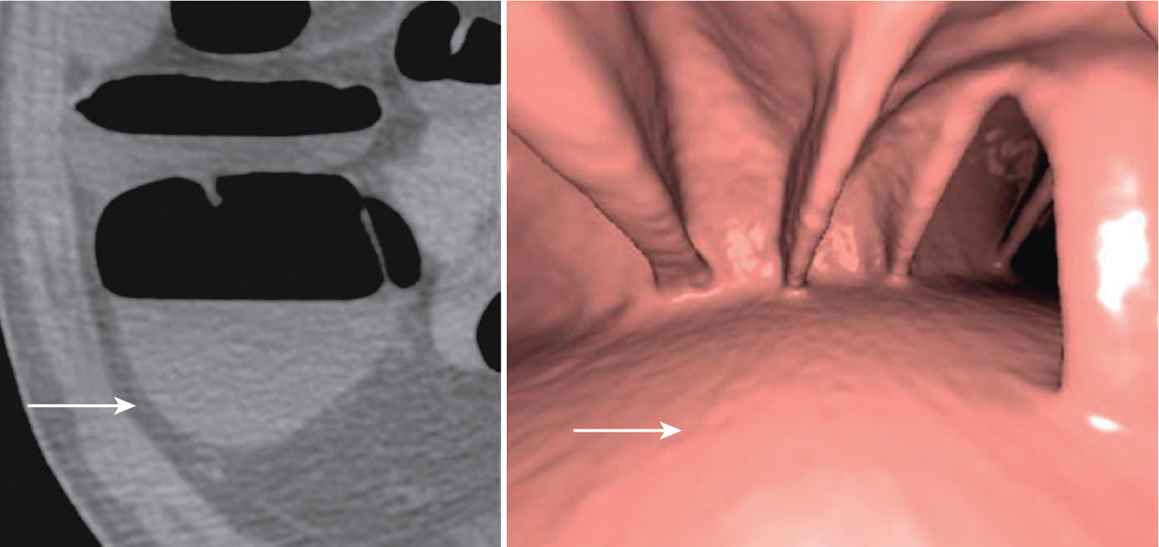 Fig. 9.1, Intraluminal fluid ( arrows , axial computed tomography [CT] image in A and three-dimensional volume rendered image in B) may limit interpretation of CT colonography.