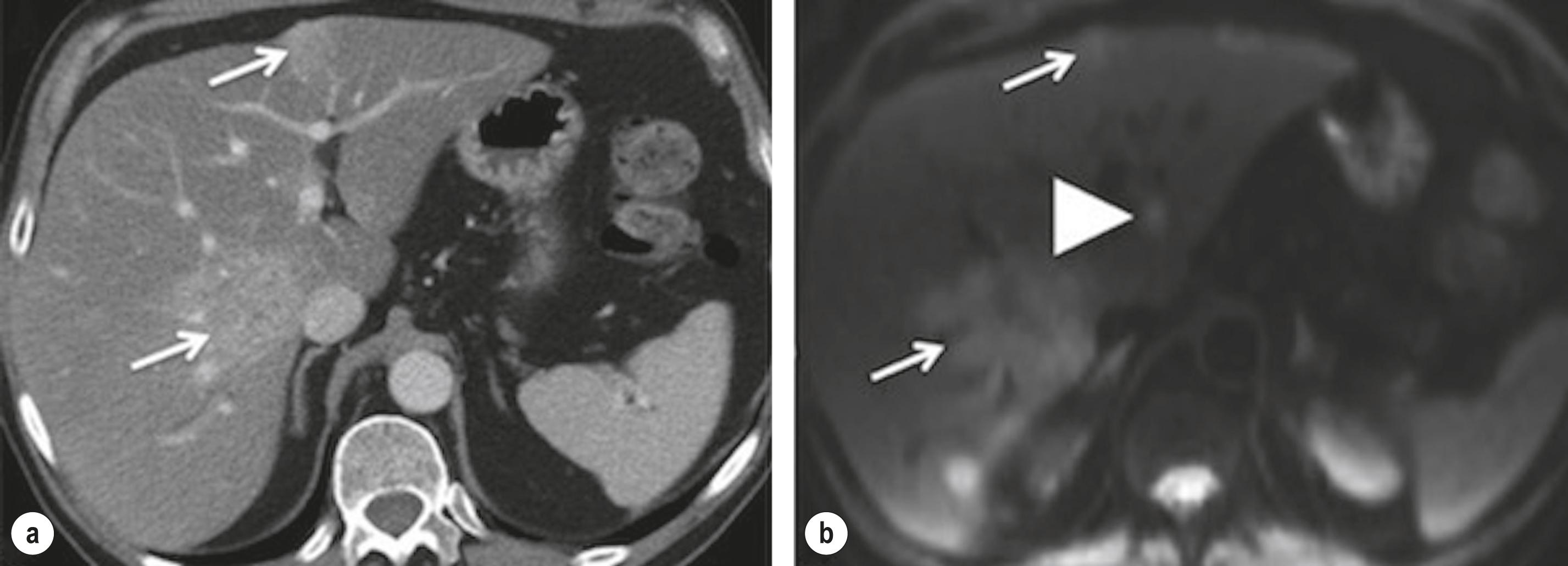 Figure 7.1, (a) Axial contrast-enhanced portal venous phase computed tomography of the liver shows the presence of two metastases (thin arrows) ; (b) diffusion MRI (b = 100 s/mm 2 ): identification of an additional metastasis in segment 2 (arrowhead).
